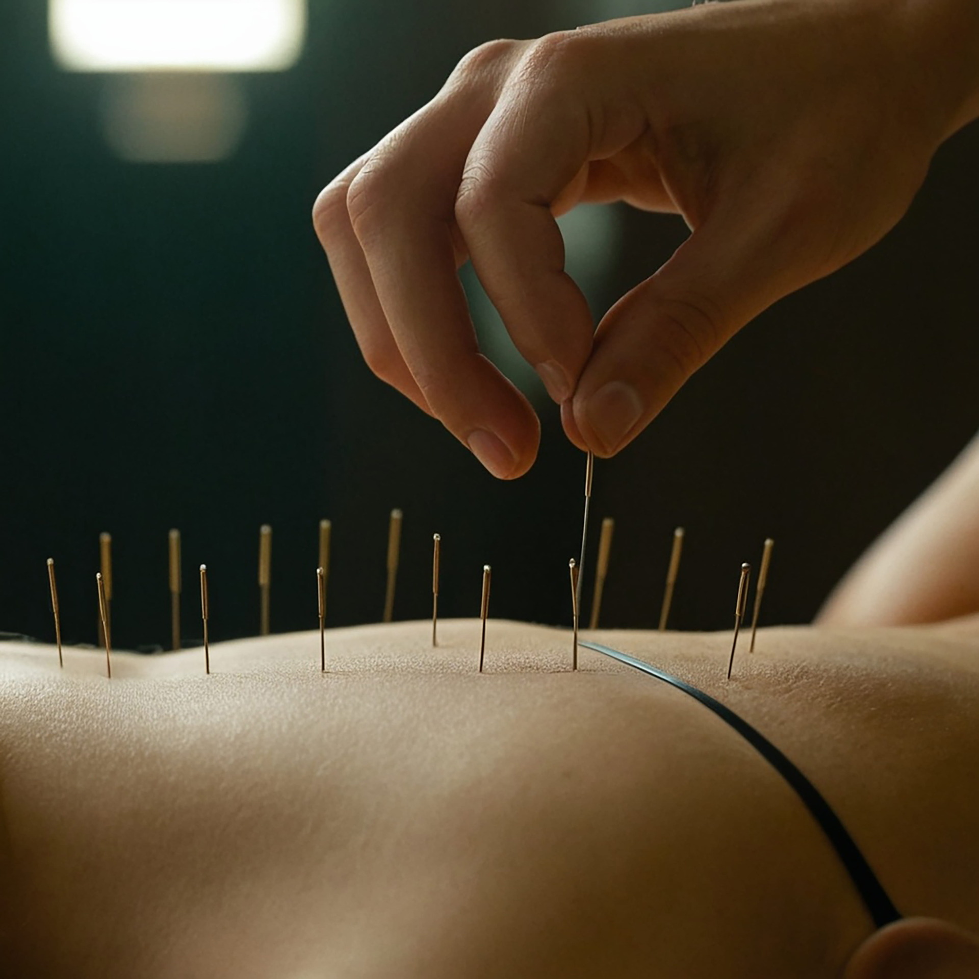 Acupuncture
